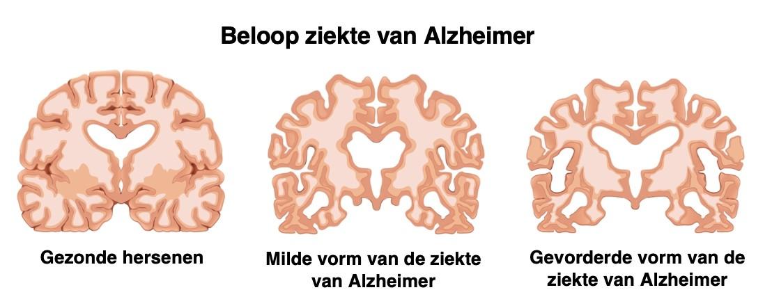 Ziekte Van Alzheimer Dementie Ziekte Van Alzheimer Dementie